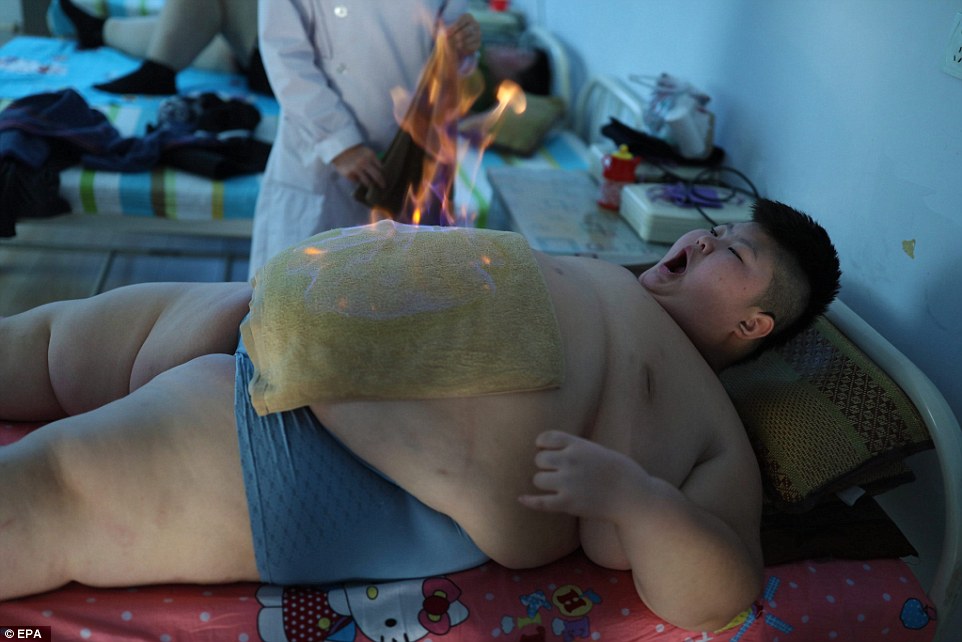 Terapia cu foc a luat nastere in centrele care lupta impotriva obezitatii din China