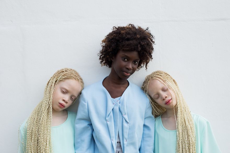 Sora mai mare a fetelor nu sufera de albinism