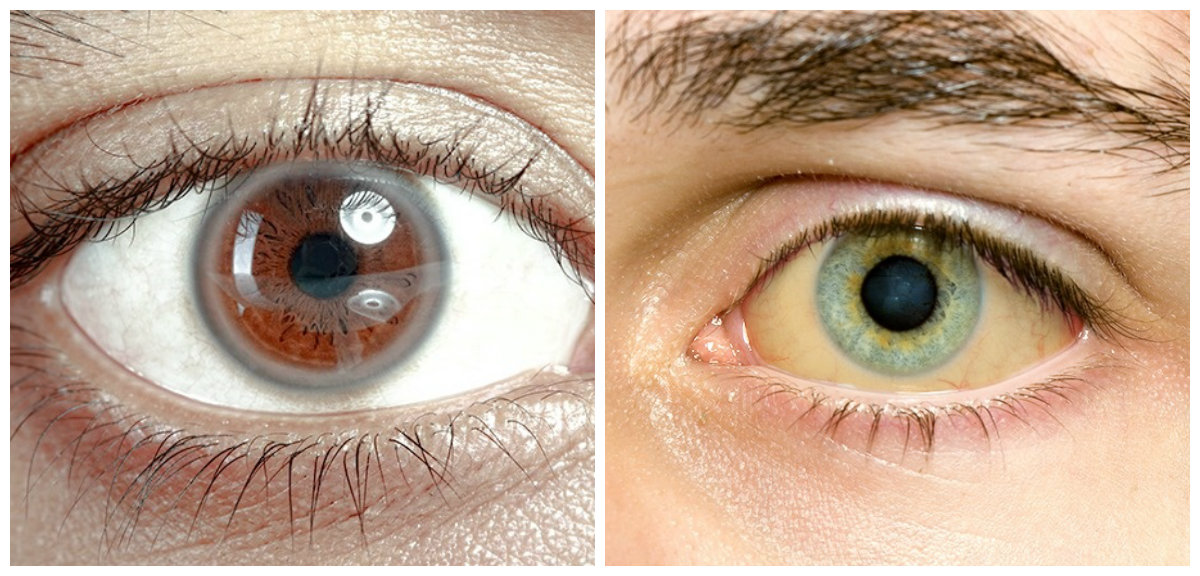 boli ale ochilor la oameni