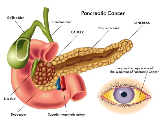 Aplicatia care iti spune daca ai cancer la pancreas