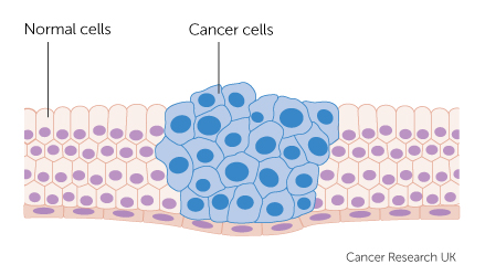 Cum poti preveni cancerul