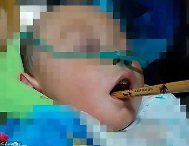 copil a ajuns la spital cu un betisor infipt in creier