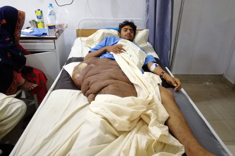 Tumora de 20 de kg care i-a distrus viata unui student