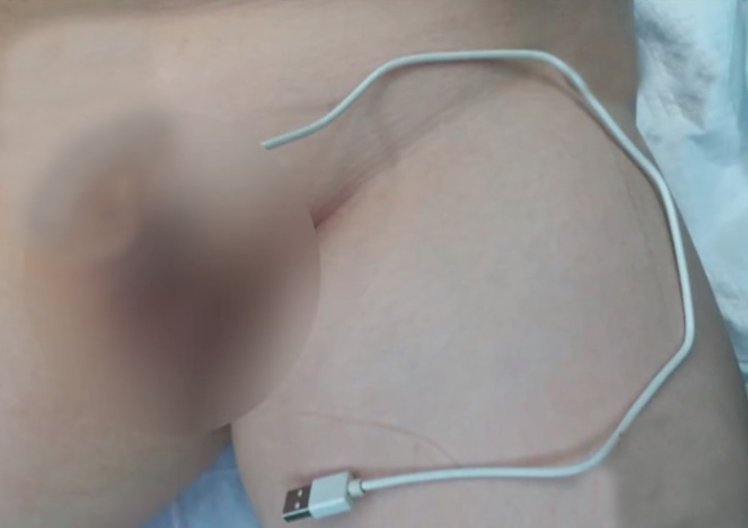 Un baiat de 13 ani si-a maltratat penisul. Ce i-a trecut prin cap sa isi bage in el. A ajuns la spital urgent!