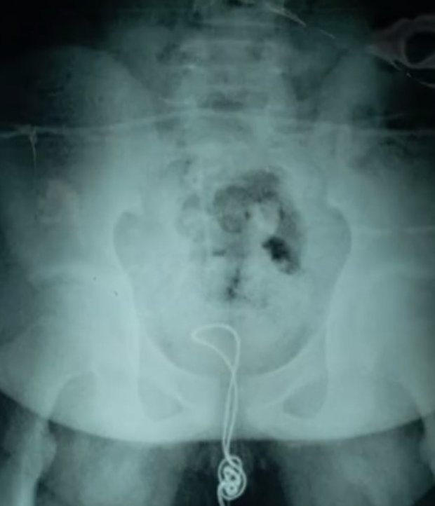 Doctorul a taiat penisul crezand ca e testicul - Arhiva noiembrie - centenardigital.ro