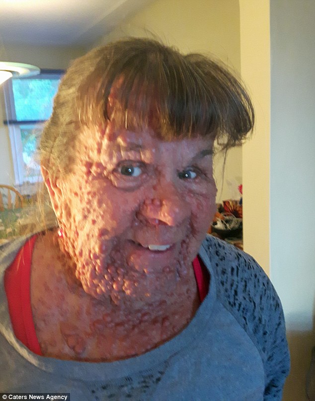 Boala neurofibromatoza i-a distrus viata unei femei. Are 57 de ani, dar oamenii o resping din cauza bubelor de pe corp