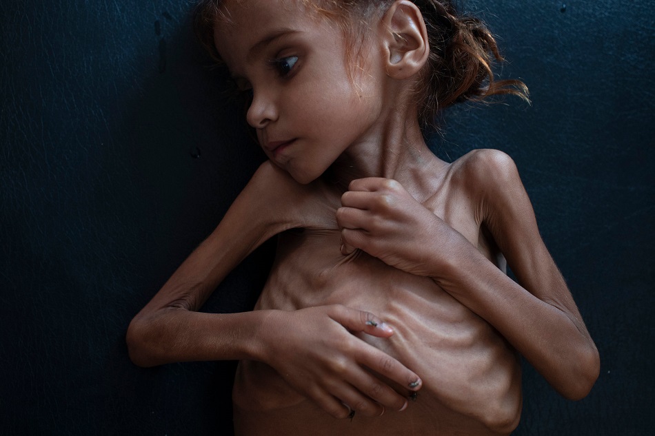 A murit fetita de 7 ani din Yemen