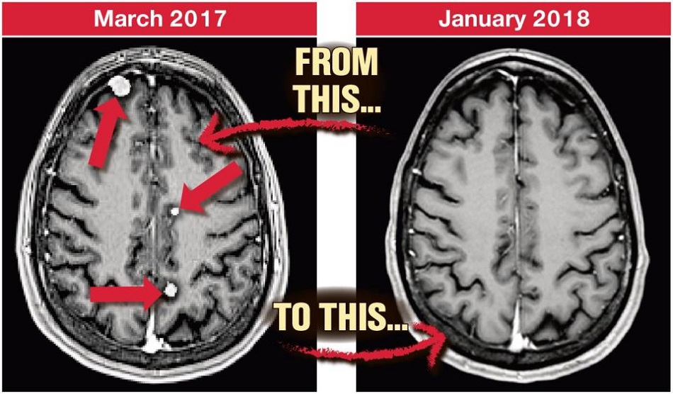 Medicii i-au dat doar 6 luni de trait si au anuntat-o ca are 25 de tumori pe creier