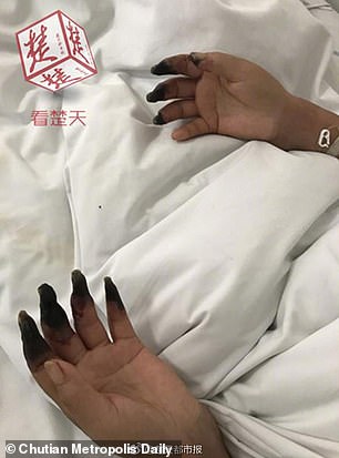 Unei femei i-au putrezit degetele de la maini