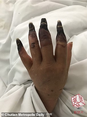 Unei femei i-au putrezit degetele de la maini