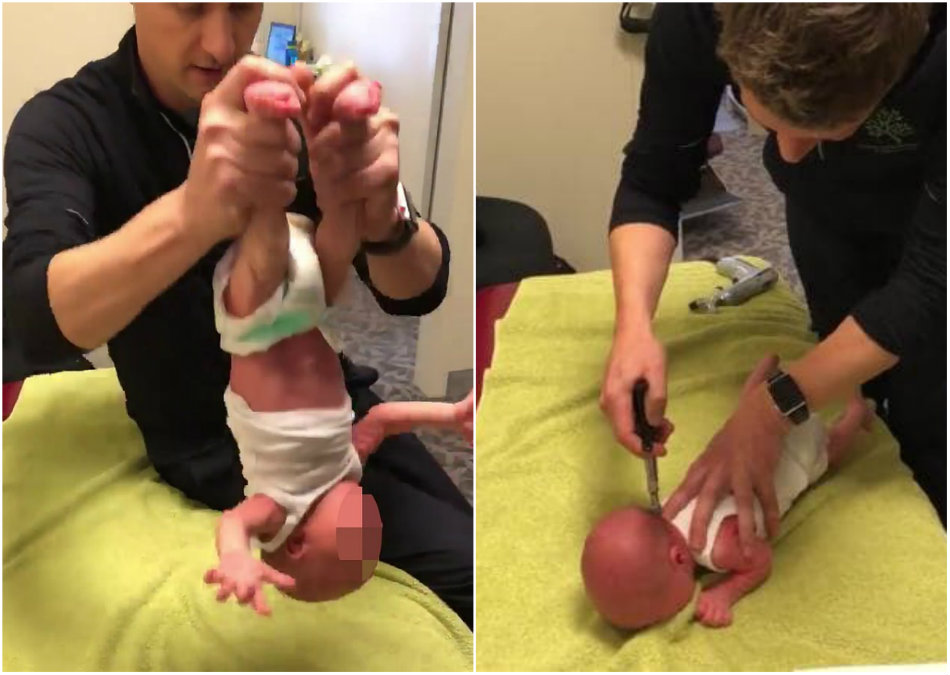 Tehnica socanta aplicata unui bebelus de 2 saptamani