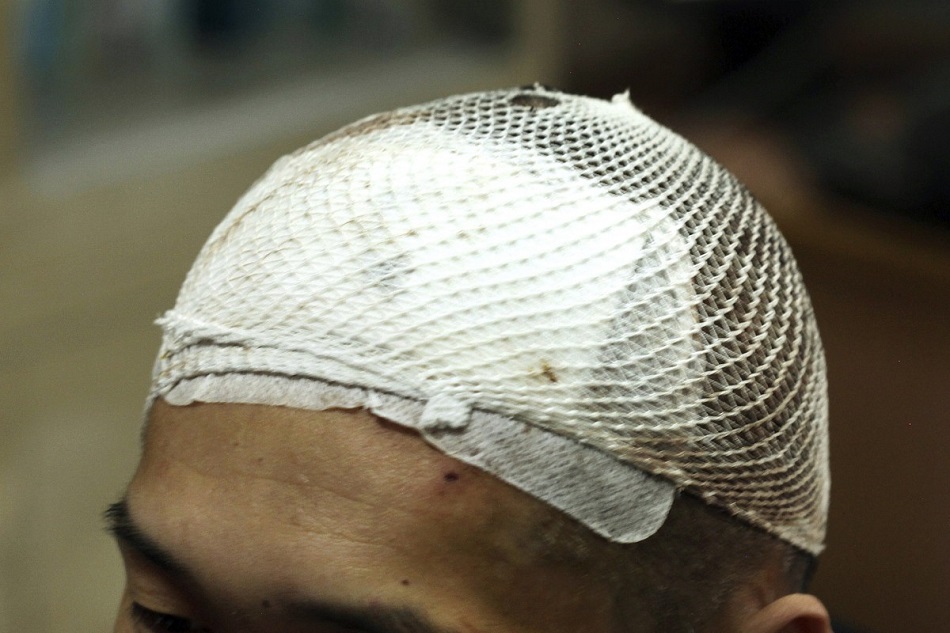 Implanturile cerebrale, cea mai noua metoda de vindecare