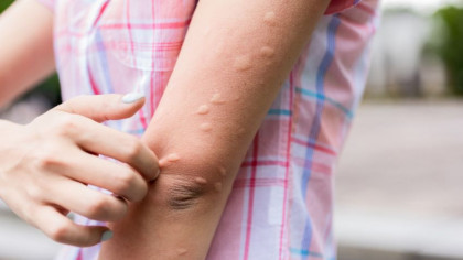 Motive pentru care ţânţarii te înţeapă mai mult pe tine decât pe alţii